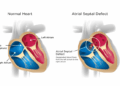 Aortic Valve Disease Causes And 2024 Insights | Vejthani