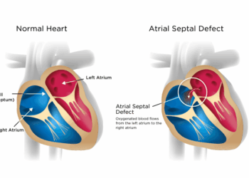 Aortic Valve Disease Causes And 2024 Insights | Vejthani