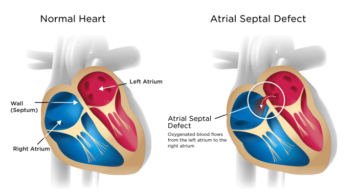 Aortic Valve Disease Causes And 2024 Insights | Vejthani