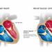 Aortic Valve Disease Causes And 2024 Insights | Vejthani