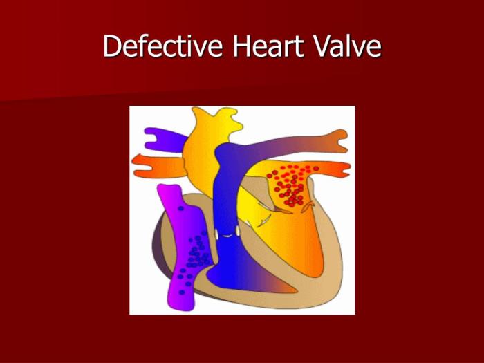Defective aortic valve of heart, CT sc | Stock Image - Science Source ...